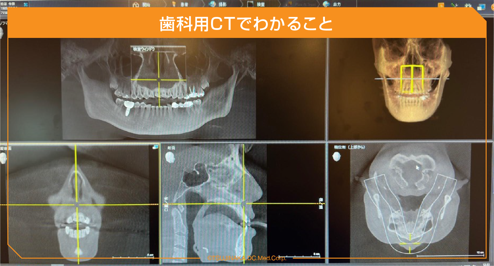 歯科用CTでわかること