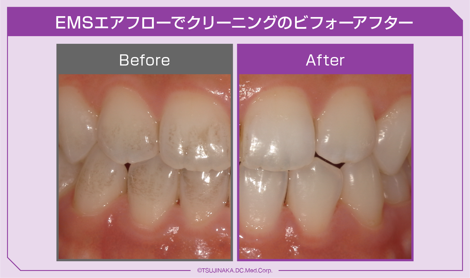 EMSエアフローでクリーニングのビフォーアフター_1