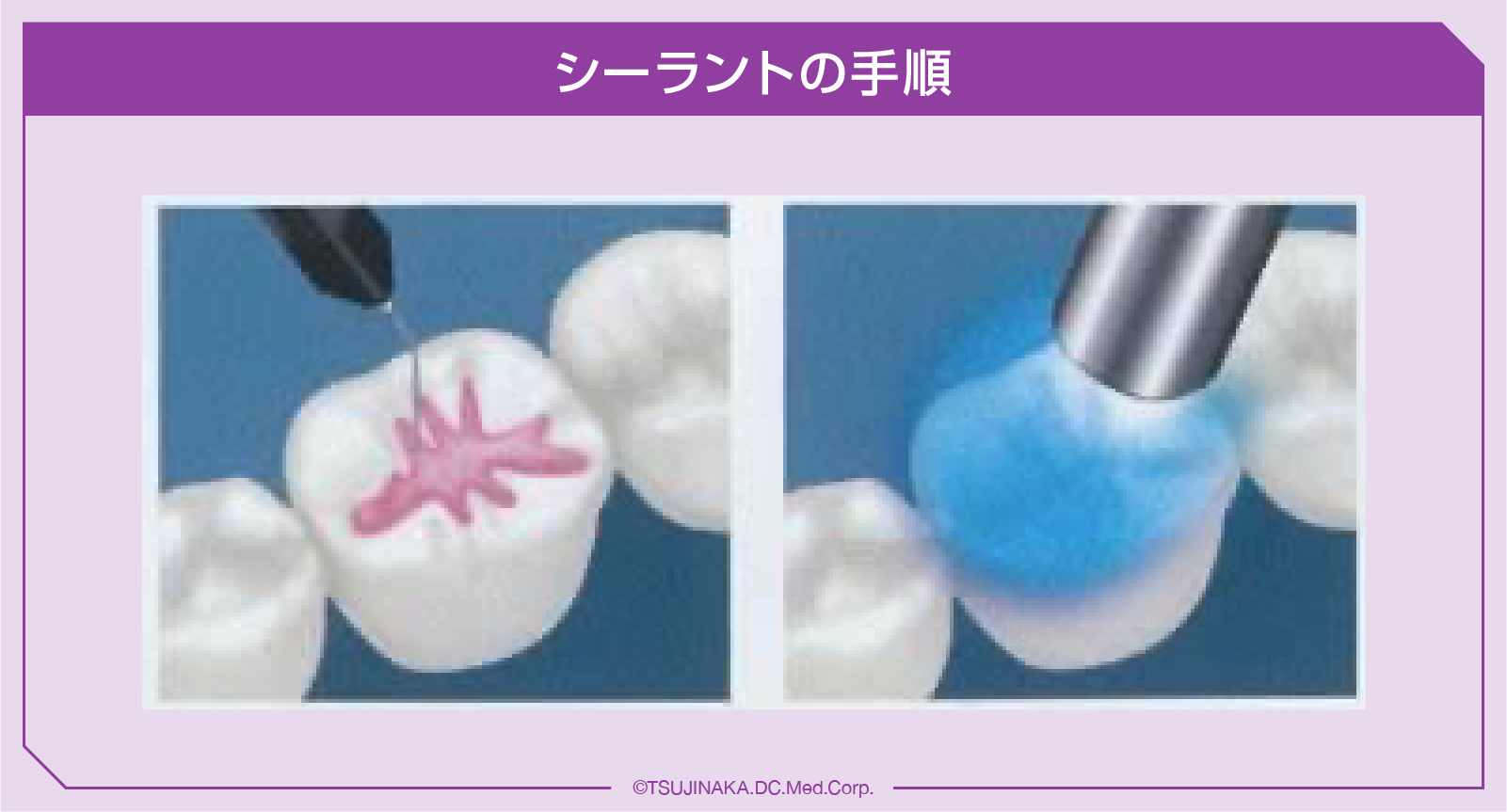 シーラントの手順