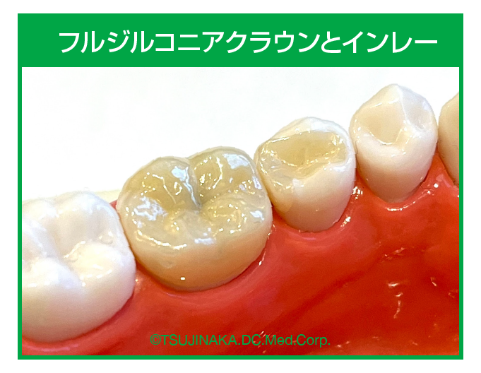フルジルコニアクラウンとインレー