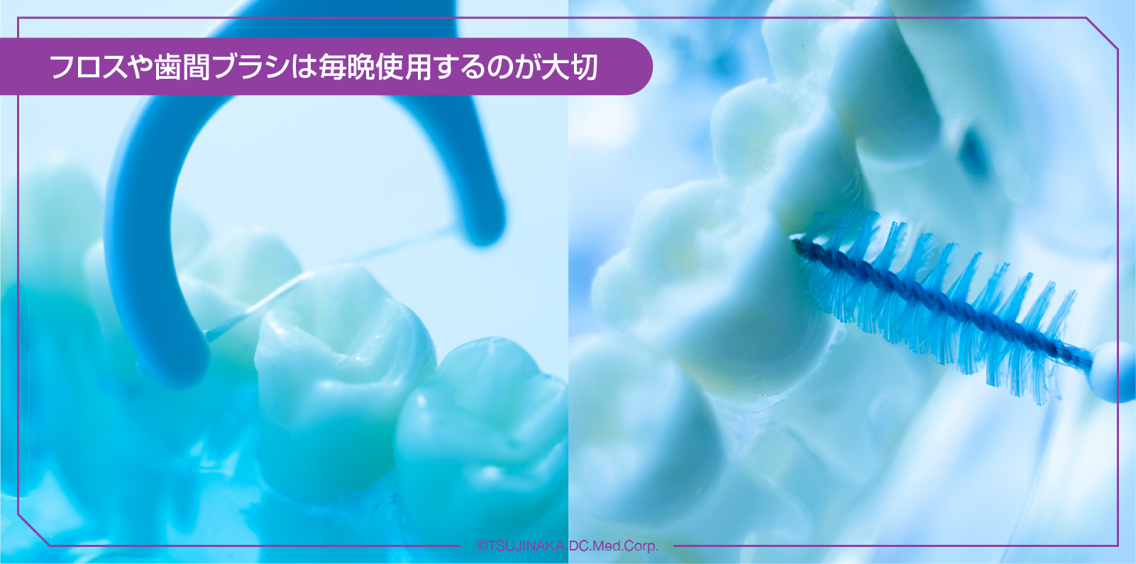 フロスや歯間ブラシは毎晩使用するのが大切