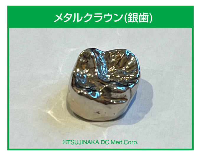 メタルクラウン(銀歯)