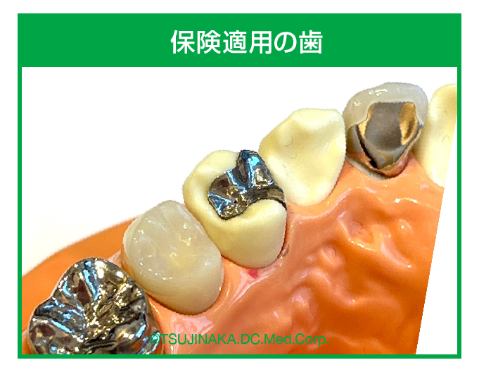 保険適用の歯