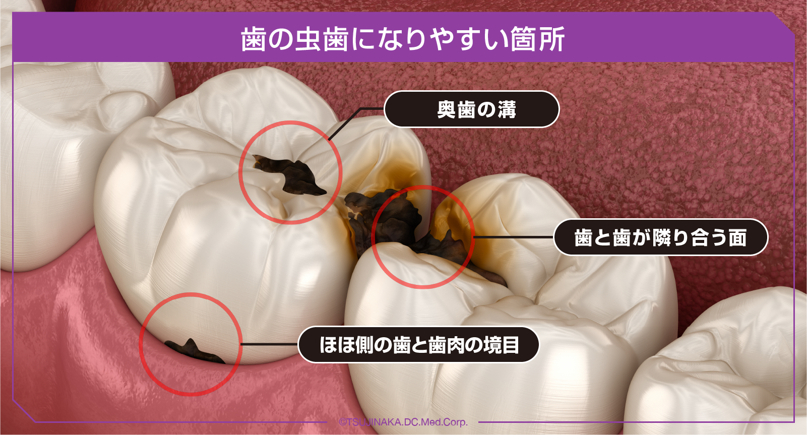 歯の虫歯になりやすい箇所