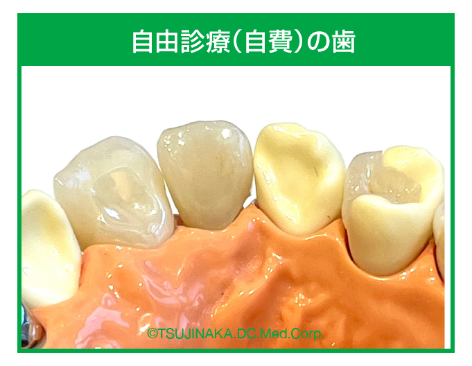 自由診療（自費）の歯