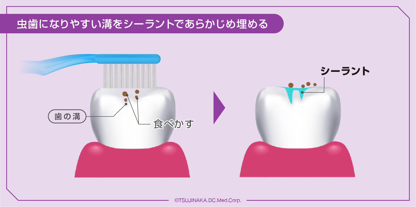 虫歯になりやすい溝をシーラントであらかじめ埋める