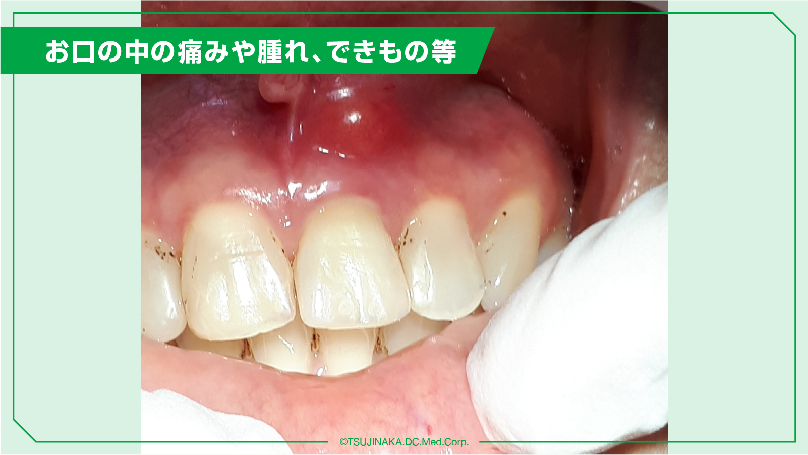 お口の中の痛みや腫れ、できもの等