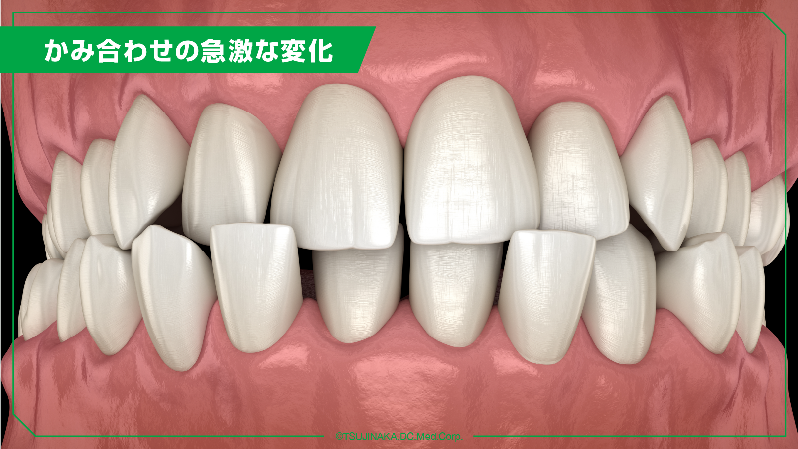 かみ合わせの急激な変化