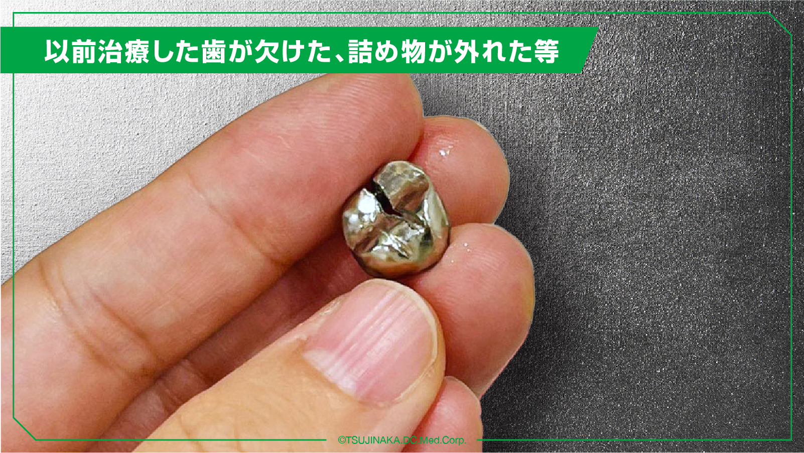以前治療した歯が欠けた、詰め物が外れた等