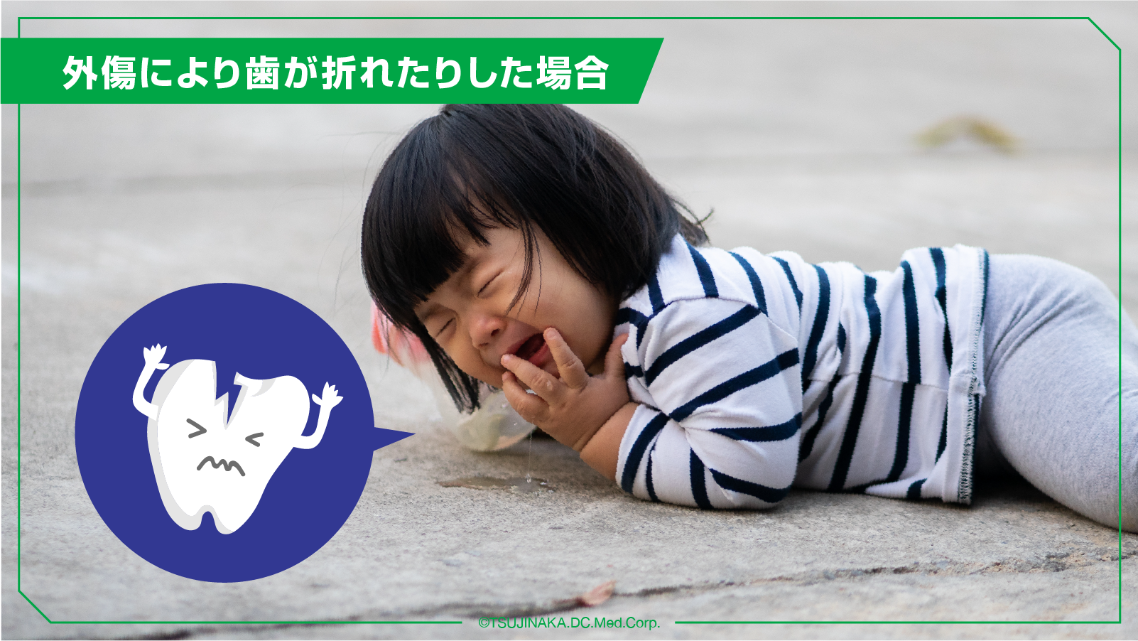 外傷により歯が折れたりした場合