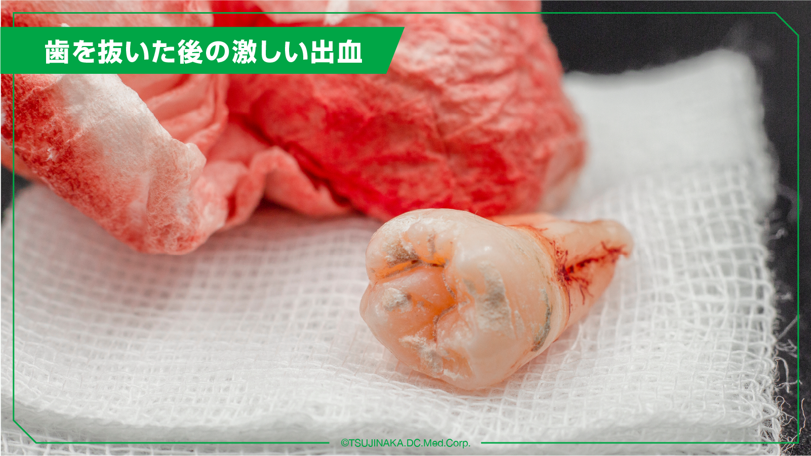 歯を抜いた後の激しい出血
