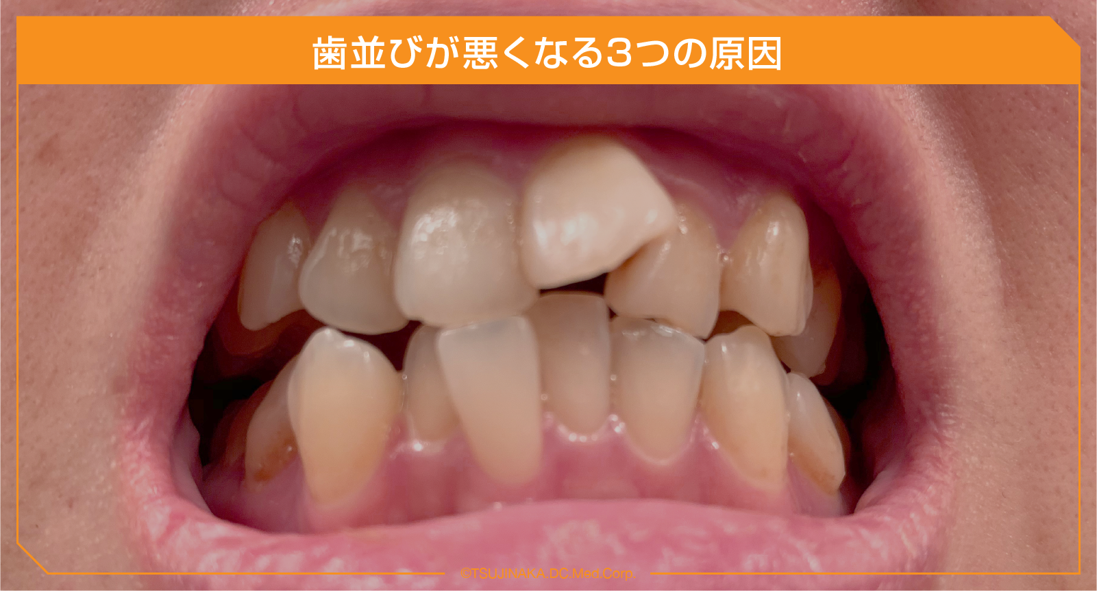 歯並びが悪くなる3つの原因