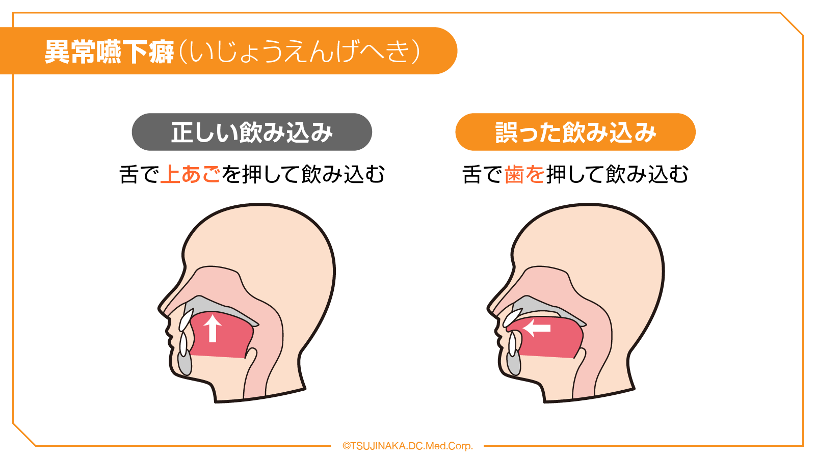 異常嚥下癖（いじょうえんげへき）