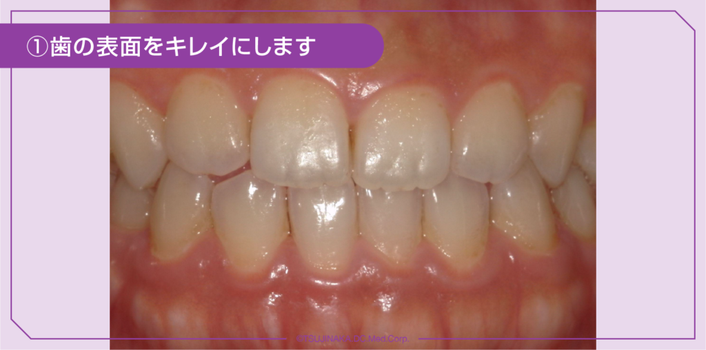 ①歯の表面をキレイにします