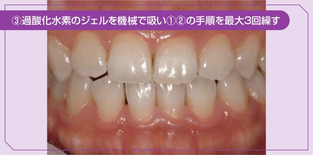③過酸化水素のジェルを機械で吸い①②の手順を最大3回繰す