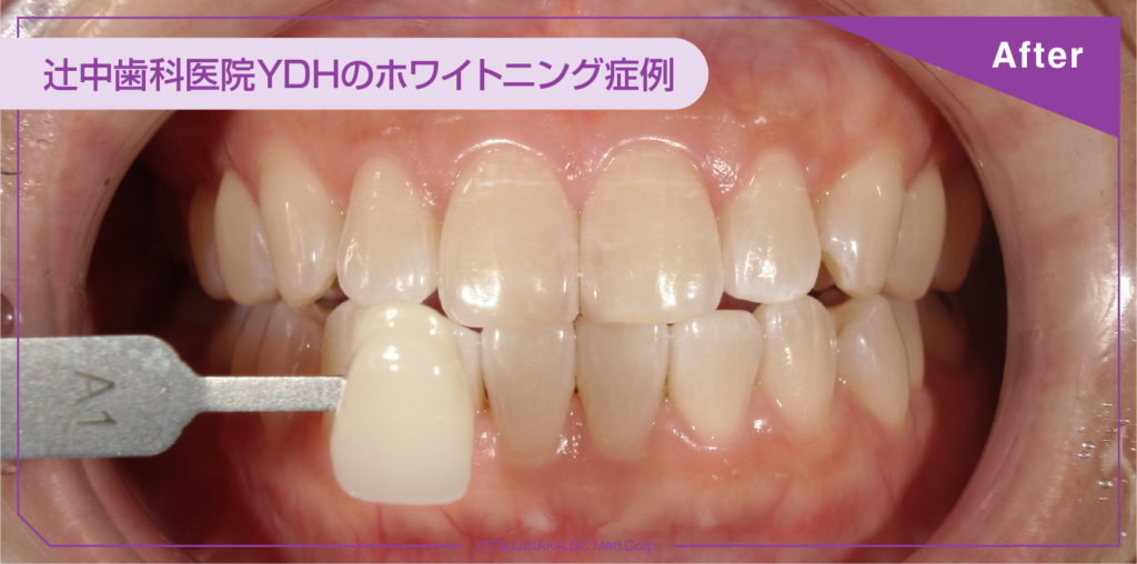 ホワイトニング症例アフター