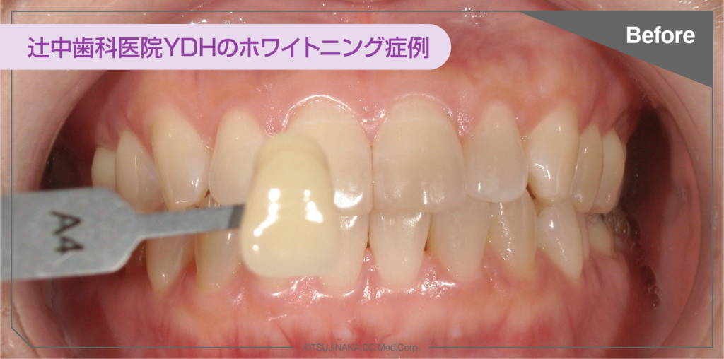 ホワイトニング症例ビフォー