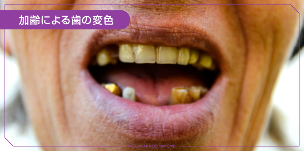 加齢による歯の変色