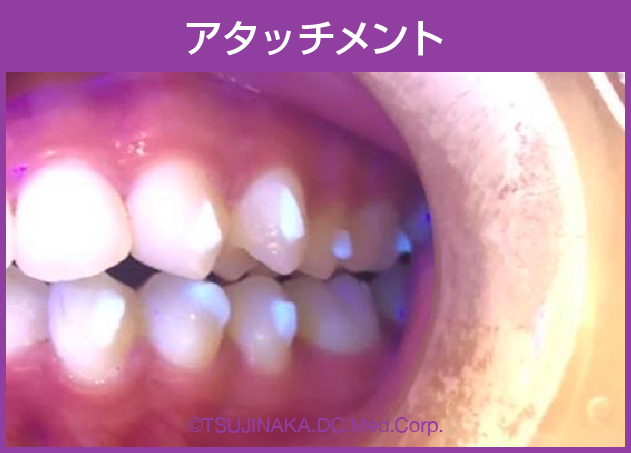 アタッチメント