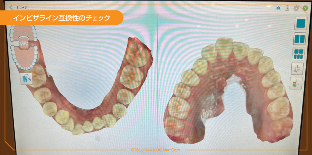 インビザライン互換性のチェック