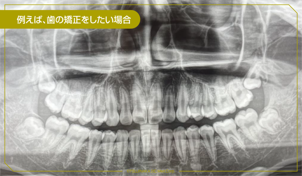例えば、歯の矯正をしたい場合