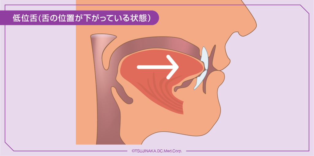 低位舌(舌の位置が下がっている状態）