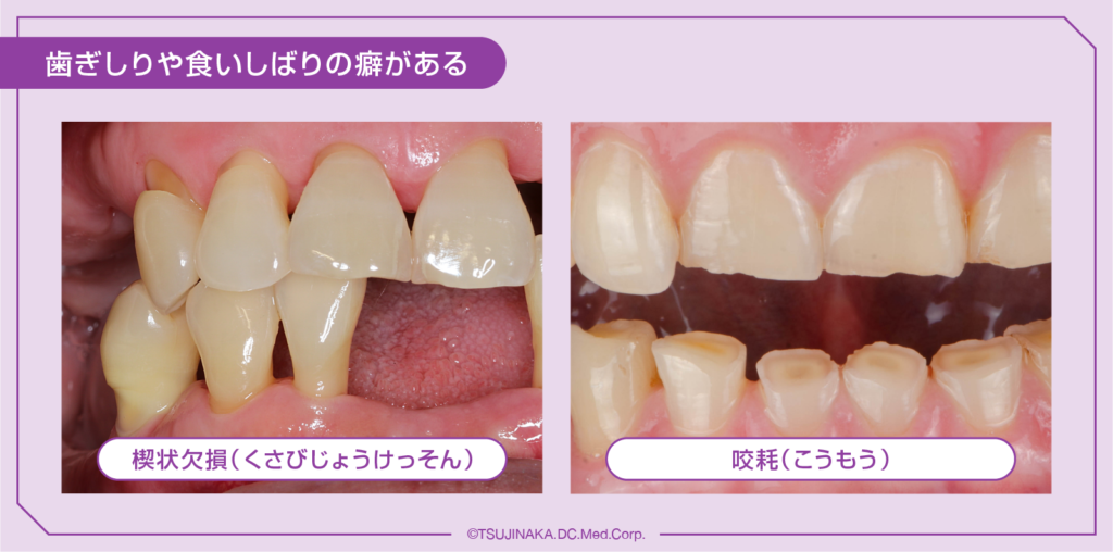 歯ぎしりや食いしばりの癖がある