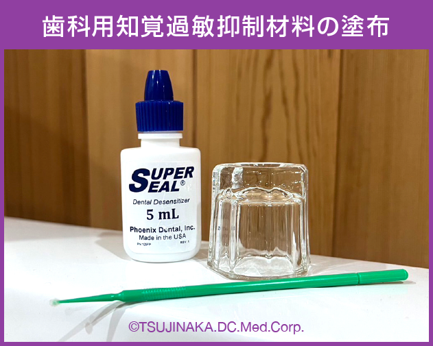 歯科用知覚過敏抑制材料の塗布