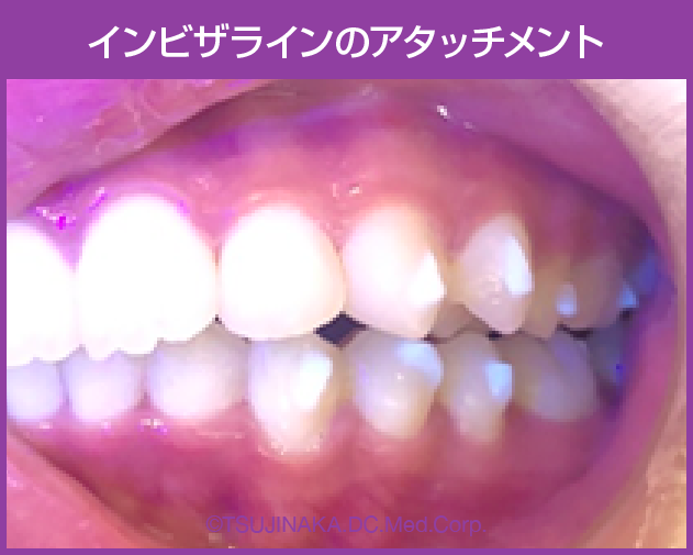 インビザラインのアタッチメント