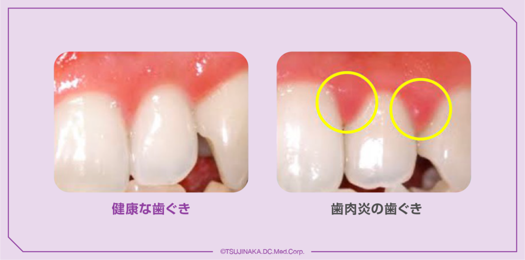 健康な歯ぐきと歯肉炎