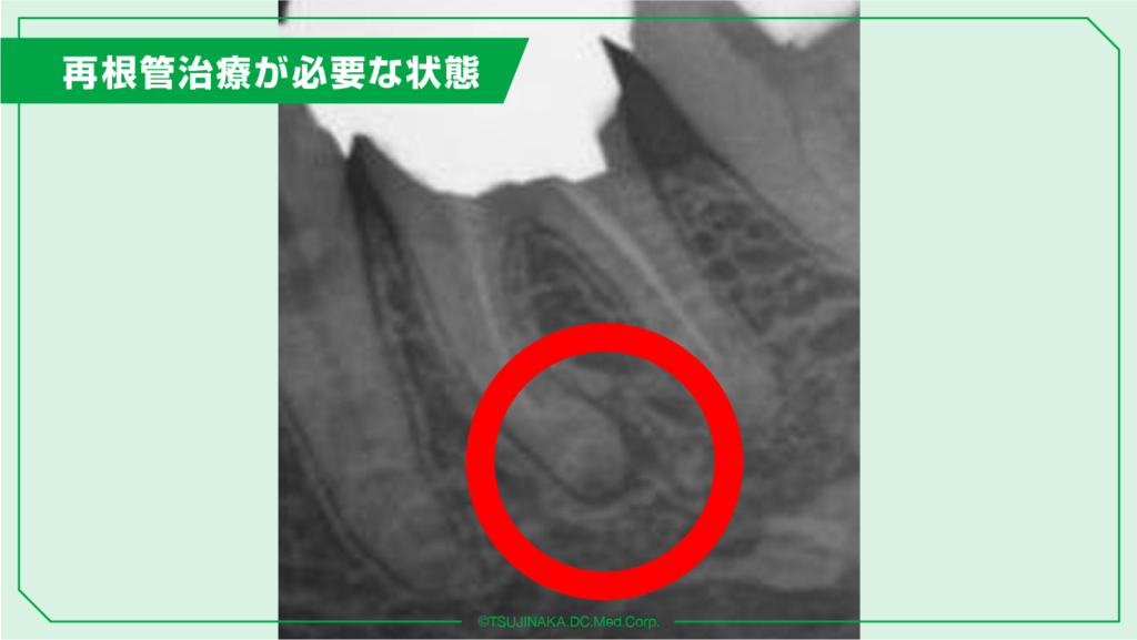 再根管治療が必要な状態