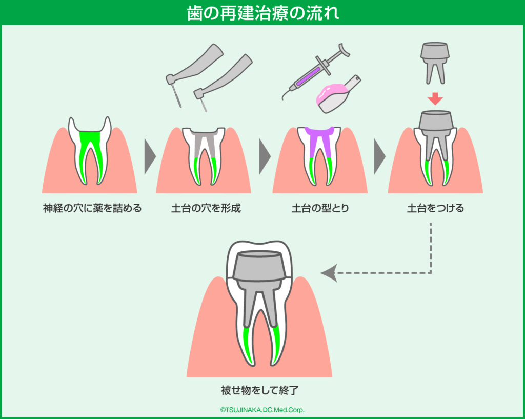 歯の再建