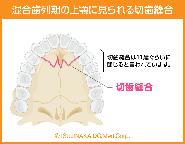 混合歯列期の上顎に見られる切歯縫合