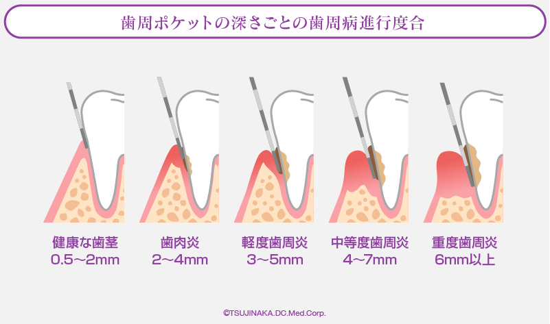 歯周ポケットの深さごとの歯周病進行度合