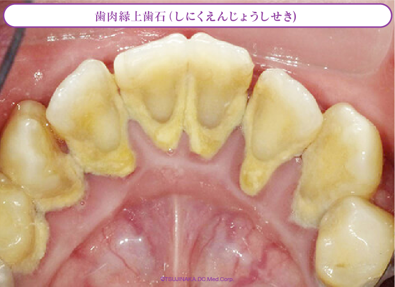 歯肉縁上歯石（しにくえんじょうしせき)