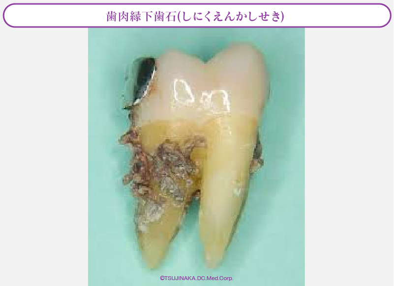 歯肉縁下歯石(しにくえんかしせき)
