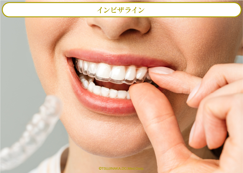 インビザライン