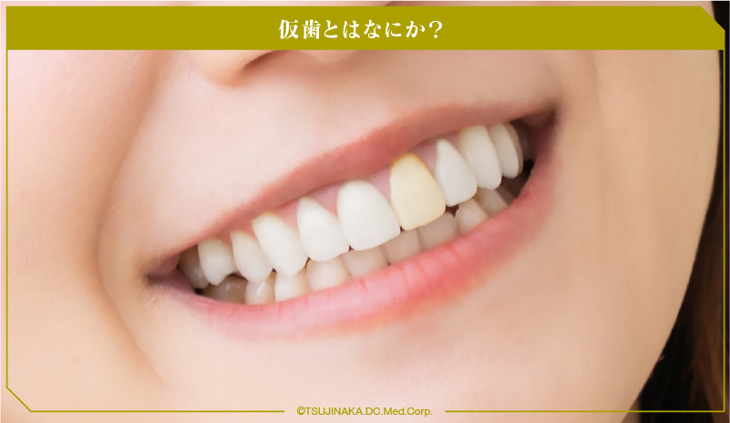 仮歯とはなにか？