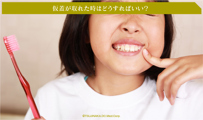 仮蓋が取れた時はどうすればいい？