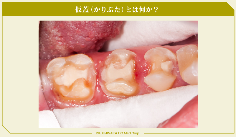 仮蓋（かりぶた）とは何か？