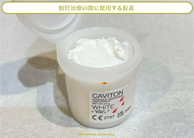 根管治療の際に使用する仮蓋