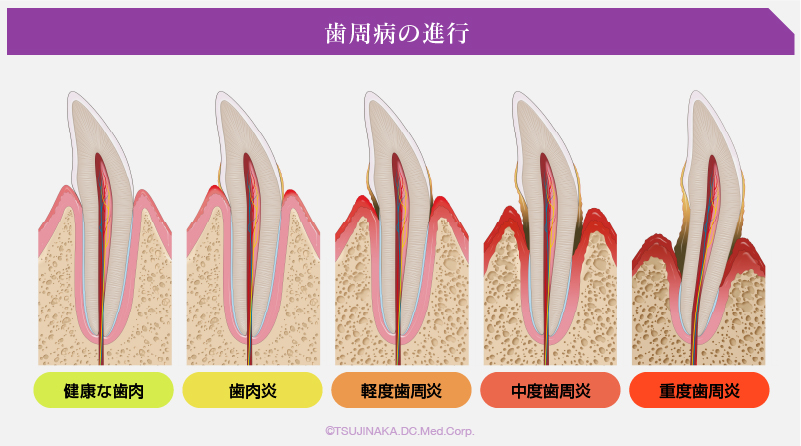 歯周病の進行