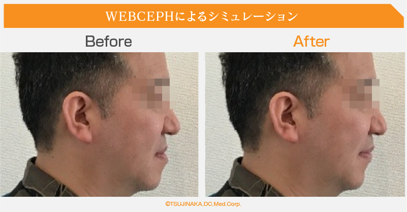 WEBCEPHによるシミュレーション
