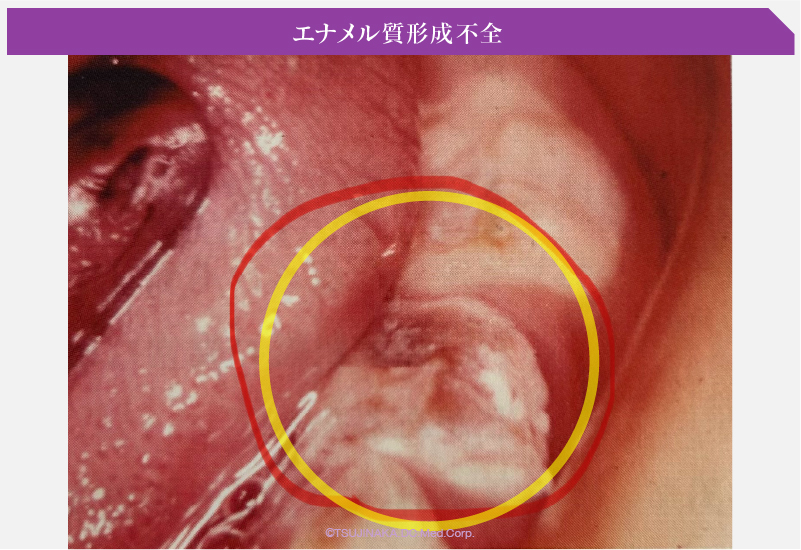 エナメル質形成不全
