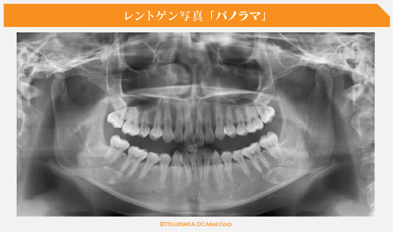レントゲン写真 「パノラマ」