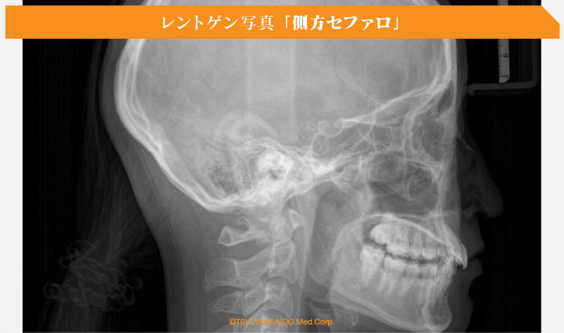 レントゲン写真 「側方セファロ」