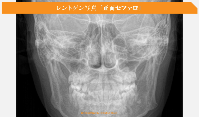 レントゲン写真 「正面セファロ」
