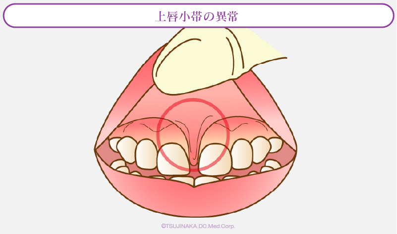 上唇小帯の異常