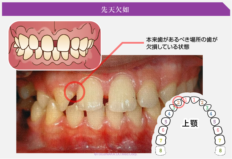 先天欠如