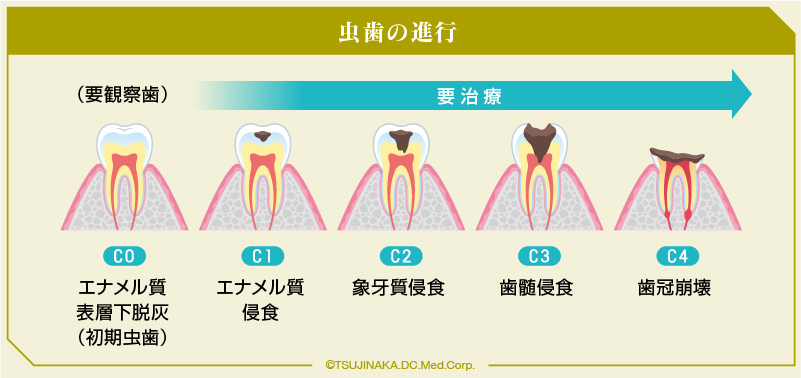 虫歯の進行
